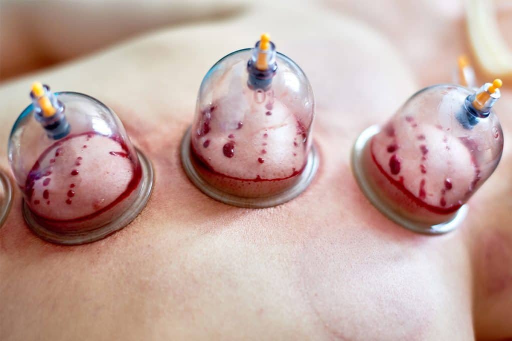 Layanan Terapi Bekam dan Pijat Spa Cantika